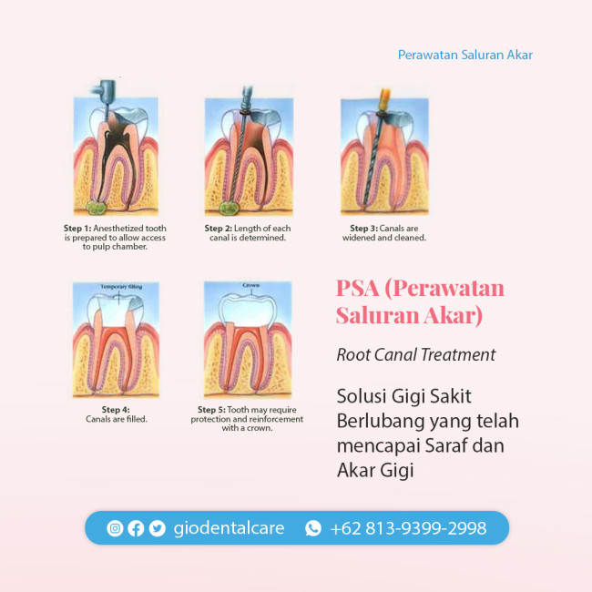 perawatan-saluran-akar-psa